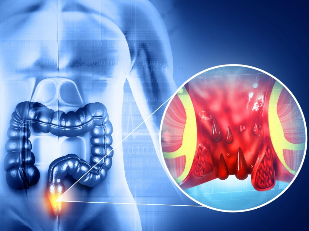 hemorrhoid-treatment-dr-farah-beshoy